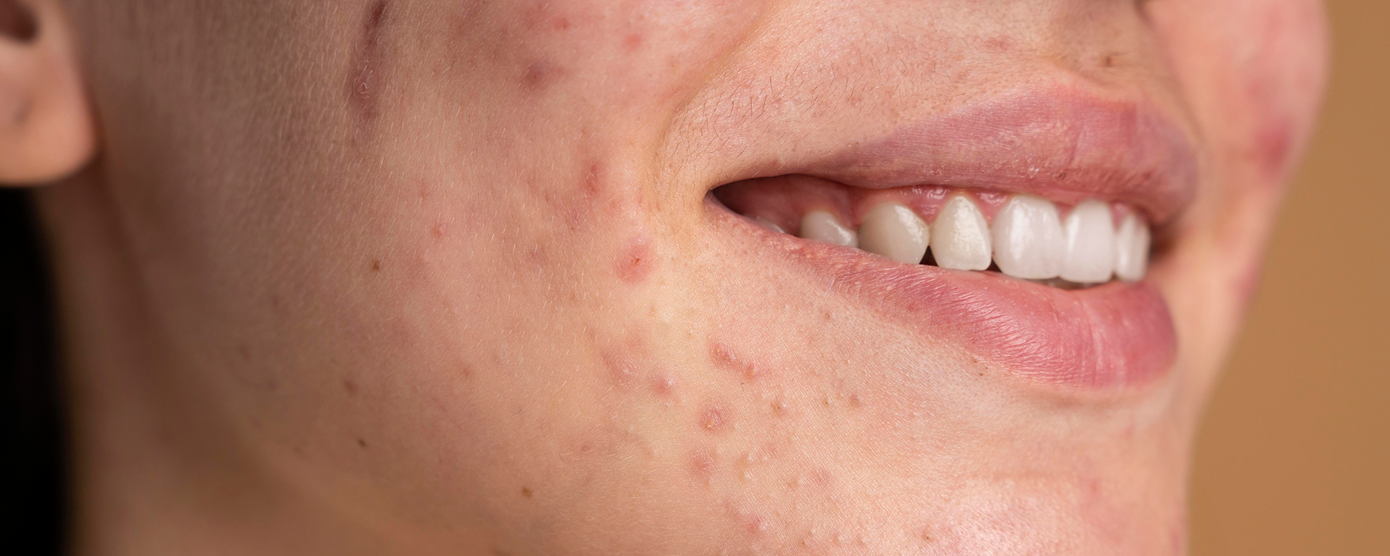 Sivilce Sonrası Kırmızı Lekeler